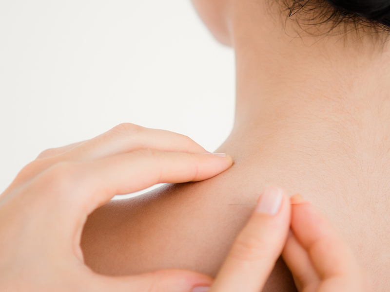 Acupuncture Services in Henley-on-Thames Oxfordshire, Berkshire, UK